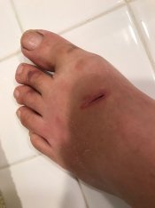 Foot injury.jpg